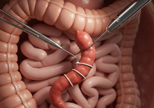 3D Laparoscopic Appendectomy