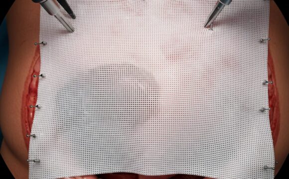 3D Laparoscopic Hernia Repairs