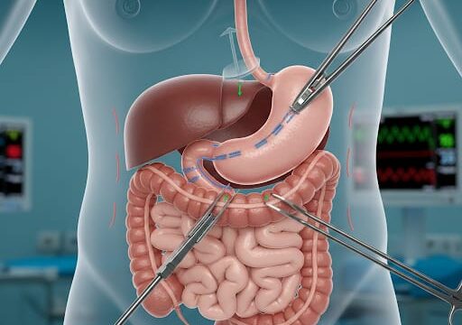 3D Laparoscopic Gastric Bypass