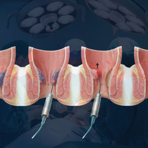 laser piles surgery.jpg Laser Piles Surgery