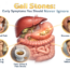 Gall Stones Early Symptoms